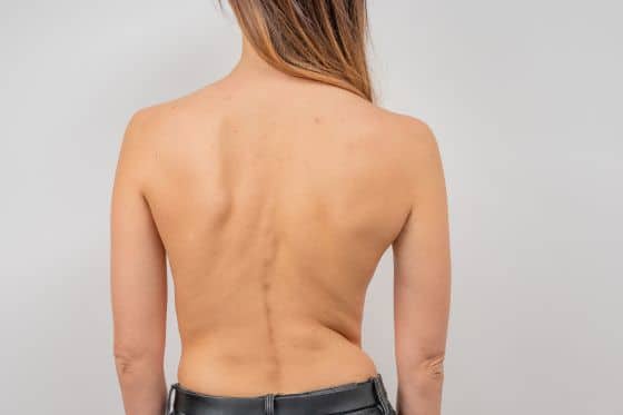 Adult Scoliosis